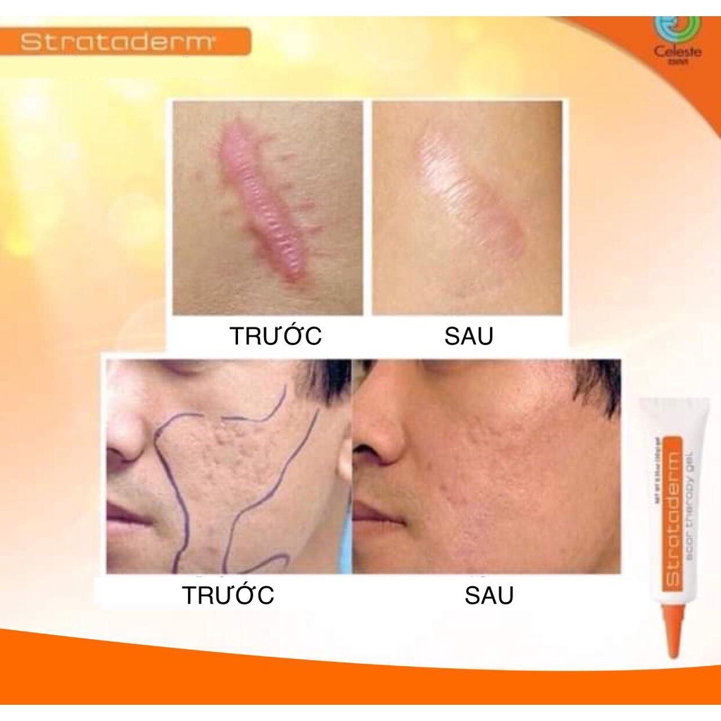 Strataderm - Gel Hỗ Trợ Làm Mờ Sẹo, Trắng Da, Mờ NámThụy Sĩ 10g