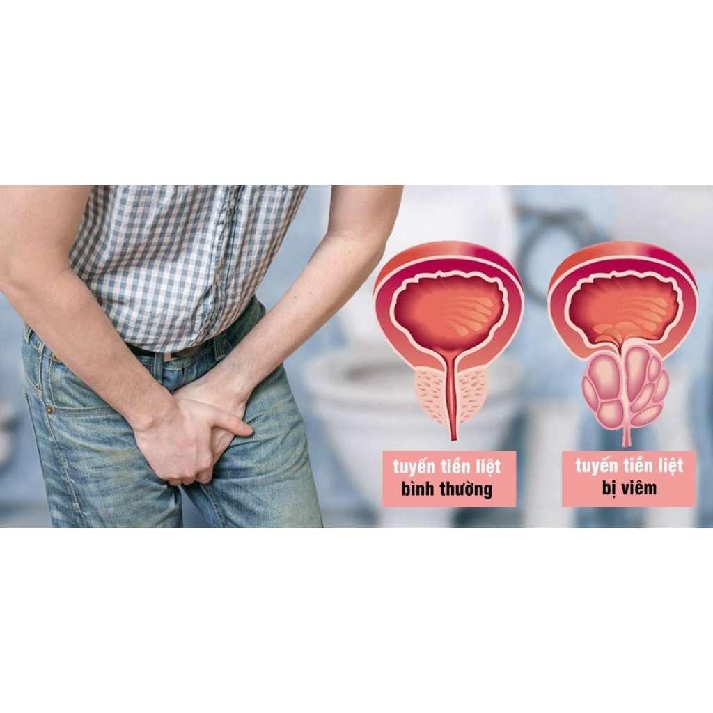 (DATE MỚI 11/2026) Vương Niệu Khang EUCARE giảm u xơ phì đại tuyến tiền liệt, tiểu đêm, bí tiểu - 50 viên