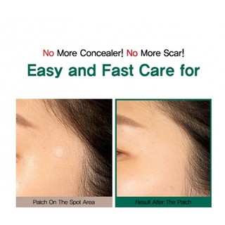[Sẵn-Nhập khẩu] Miếng Dán Mụn Some By Mi Clear Spot Patch