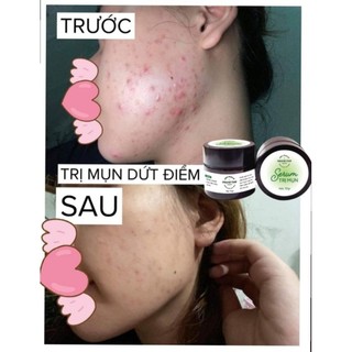 SERUM NGĂN MỤN NGỪA SẸO THÂM