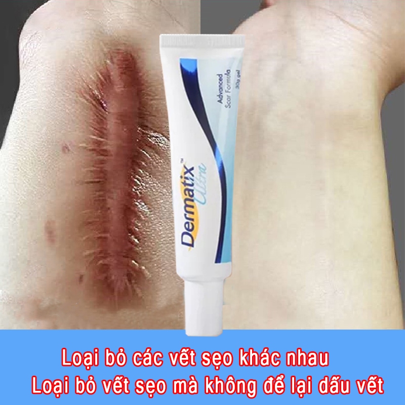 Gel Kem Làm Mờ Sẹo Thâm và làm phẳng sẹo lồi, loại bỏ vết sẹo muỗi đốt Pha loãng vết bỏng, vết sẹo cũ, Giúp Phục Hồi Da