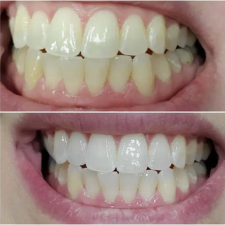BỘT LÀM TRẮNG RĂNG - LAUGH POWDER