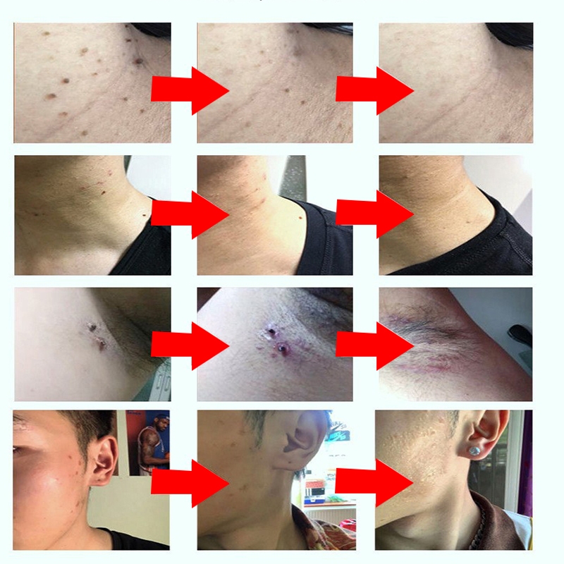 Kem Chấm Tẩy Nốt Ruồi JAYSUING, Kem Loại Bỏ Mụn Cóc, Mụn Cơm, Mụn Thịt, Mụn Cóc, Jaysuing Kem Bật Còi Mụn Thịt Dư