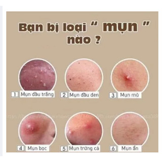 KEM MỤN SPA ACNE