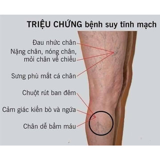 KEM BÔI TRỊ GIÃN TĨNH MẠCH ABTEI