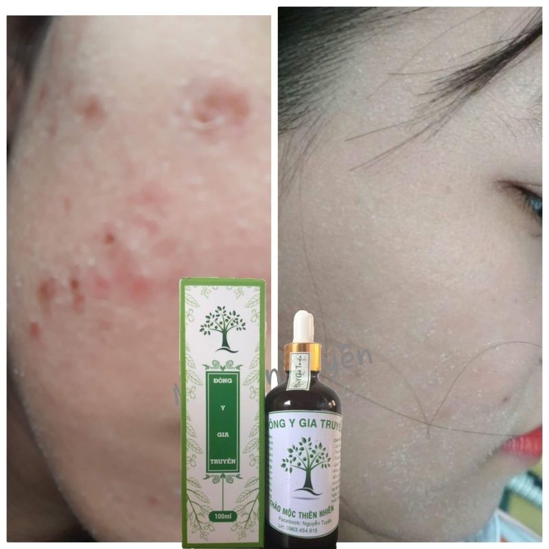 Tinh chất thảo mộc tái tạo da