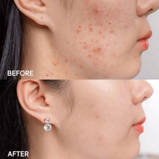 GEL MỤN DEMAFORTE giảm mụn, mờ thâm