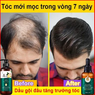 Tinh Chất Kích Thích Mọc Tóc Và Chống Rụng Tóc,Tinh dầu mọc tóc nhanh Dưỡng Tóc Nhanh 30ml