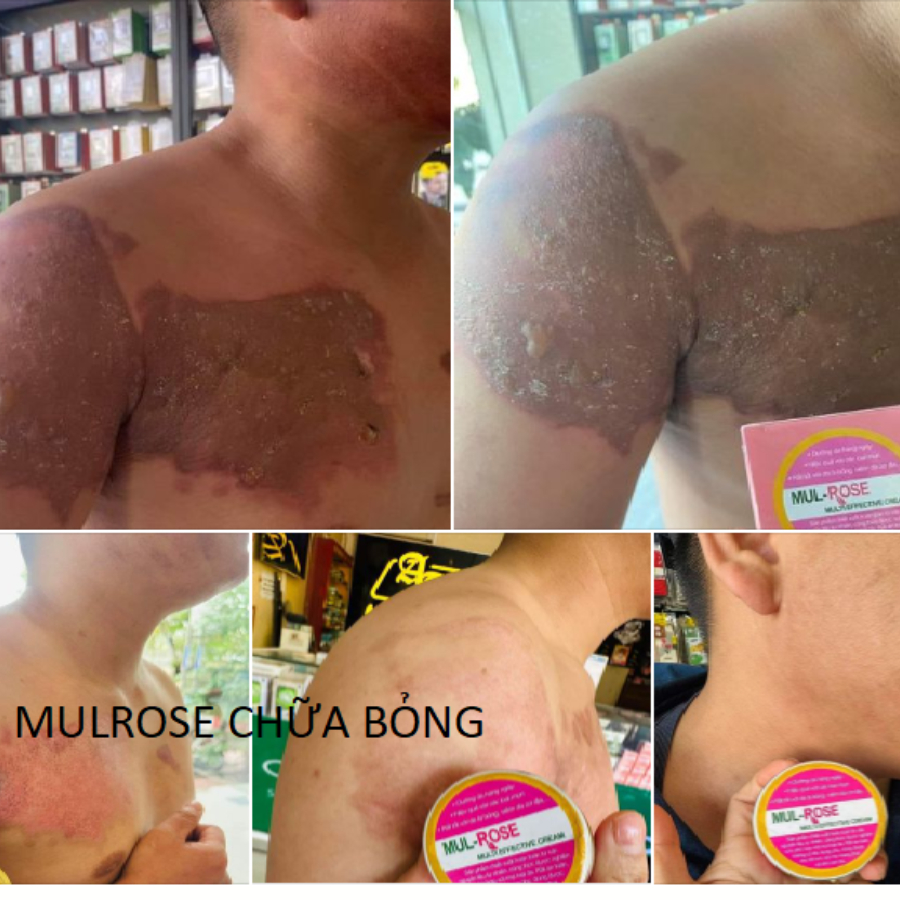 Kem Mulrose Dưỡng da cấp ẩm, hỗ trợ các vấn đề về da như bỏng, sẹo, thâm, rạn, á sừng tổ đĩa..