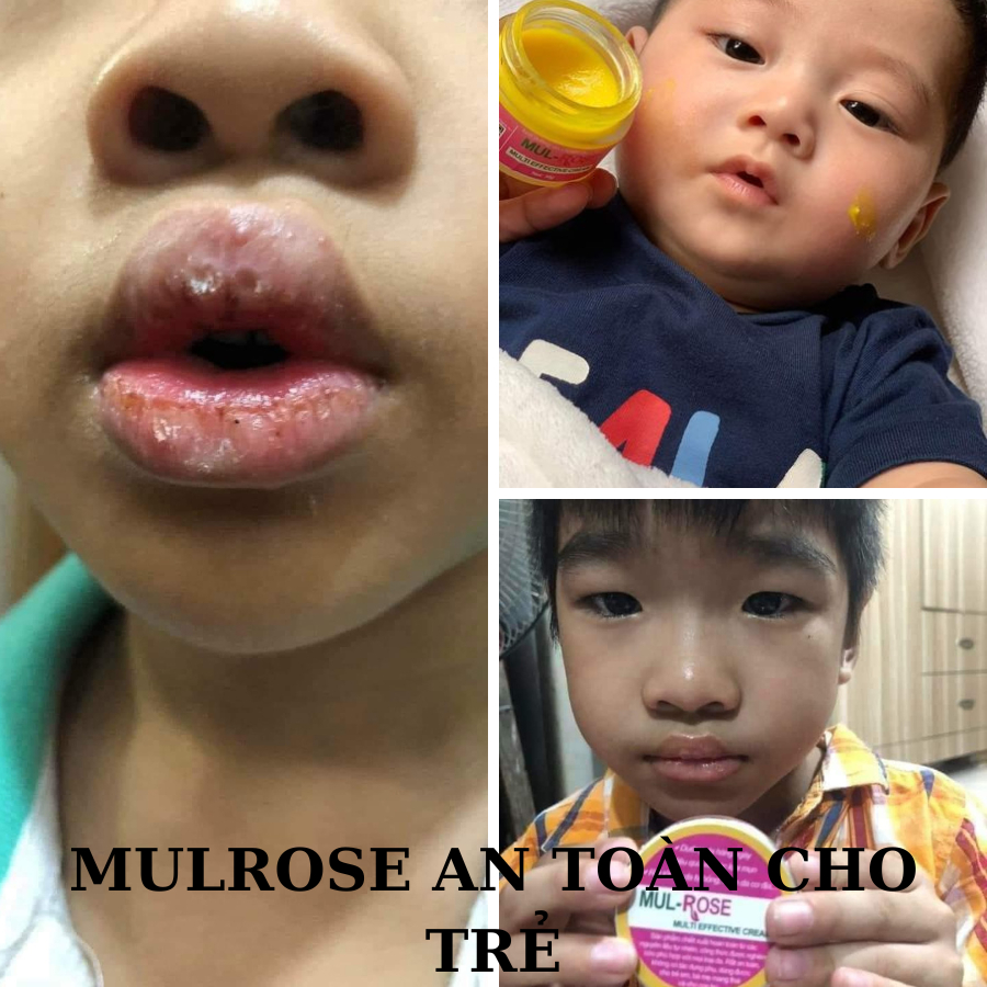 Kem Mulrose Dưỡng da cấp ẩm, hỗ trợ các vấn đề về da như bỏng, sẹo, thâm, rạn, á sừng tổ đĩa..