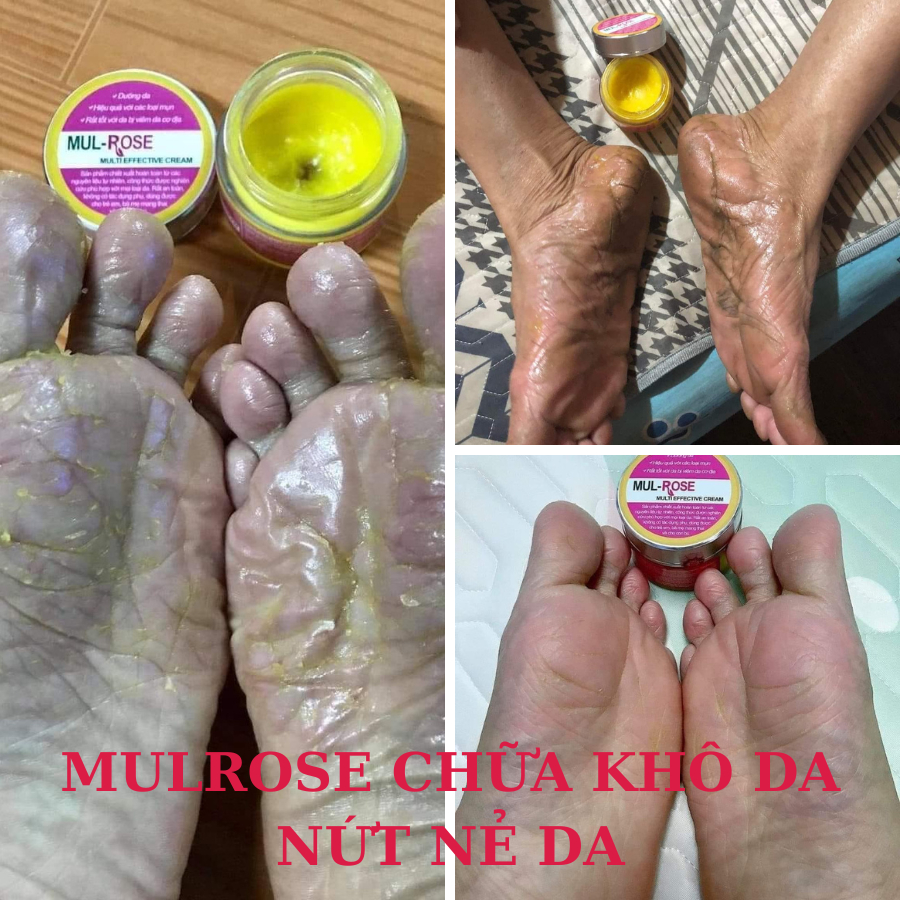 Kem Mulrose Dưỡng da cấp ẩm, hỗ trợ các vấn đề về da như bỏng, sẹo, thâm, rạn, á sừng tổ đĩa..