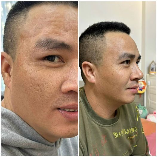 Kem Derma Wound - Eaz hỗ trợ làm mờ sẹo, mờ thâm