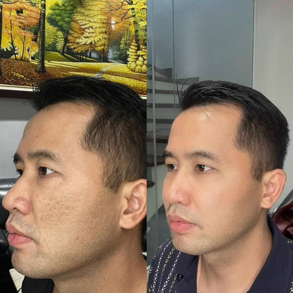 Kem Derma Wound - Eaz hỗ trợ làm mờ sẹo, mờ thâm