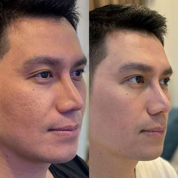 Kem Derma Wound - Eaz hỗ trợ làm mờ sẹo, mờ thâm