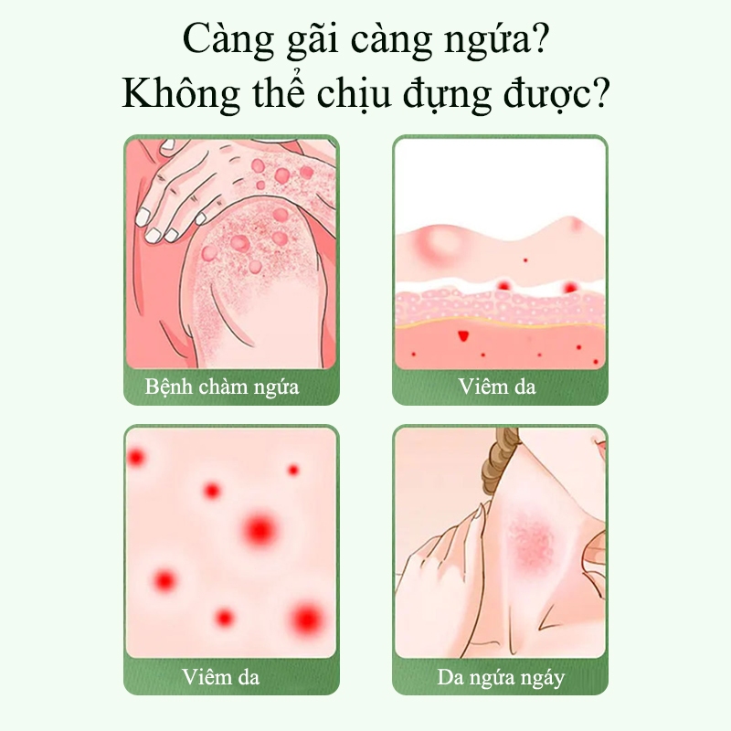 Kem bôi nấm ngứa Kem giảm ngứa 30g Dịu nhẹ Nhanh chóng Kháng khuẩn giảm ngứa Lang ben Bệnh chàm ngứa Vảy nến