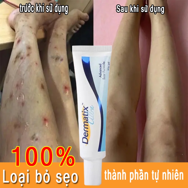 Gel Kem Làm Mờ Sẹo Thâm và làm phẳng sẹo lồi, loại bỏ vết sẹo muỗi đốt Pha loãng vết bỏng, vết sẹo cũ, Giúp Phục Hồi Da