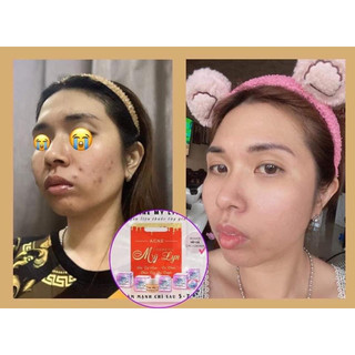 ACNE MỸ LYN kem chấm mụn