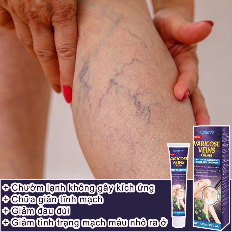 Kem Suy Giãn Tĩnh Mạch HBESTY Varicose Veins Cream - Kem Bôi Giãn Tĩnh Mạch Cải Thiện Lưu Thông Tĩnh Mạch