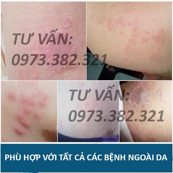 Kem Bôi Viêm Da Cơ Địa Nấm Ngứa BỌ CẠP Hắc Lào, Tổ Đỉa, Vẩy Nến, Á Sừng, Lang Ben Hiệu Quả