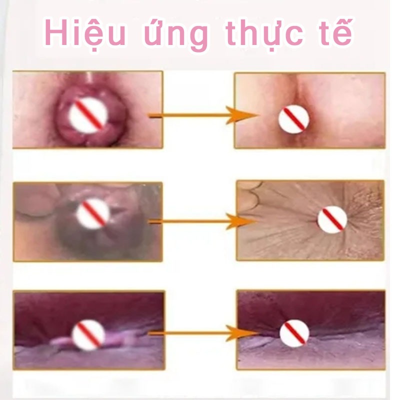 Kem bôi giảm các triệu chứng của trĩ và teo đau sưng tấy làm sạch, Đánh Bay Nứt Hậu Mômkháng khuẩn,Loại bỏ bệnh nội