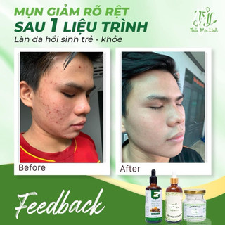 [CHÍNH HÃNG] Combo Đông Y Thảo Mộc Linh.