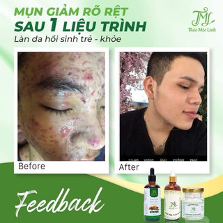 [CHÍNH HÃNG] Combo Đông Y Thảo Mộc Linh.