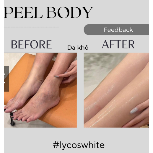 Tinh Chất Lycos White Dưỡng Body BHA AHA - Lycos White body lotion Không Bong Tróc Dưỡng Body mịn màng, trắng sáng