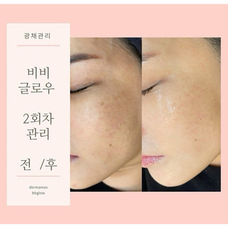 Cấy phấn trắng da Meso BB Dr Solution tách lẻ 1 lọ