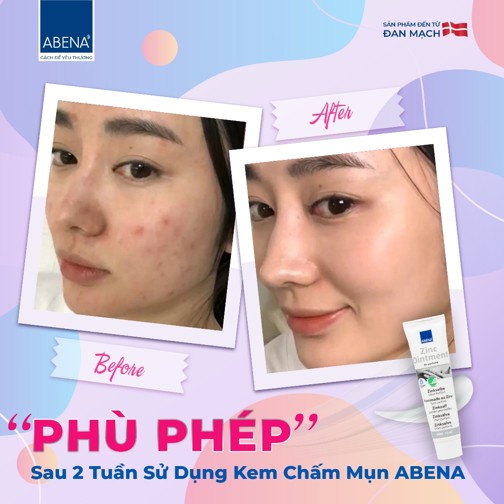 Kem giảm mụn làm mờ thâm gom cồi ABENA thông thoáng lỗ chân lông tuýp 15ml nhập khẩu Đan Mạch