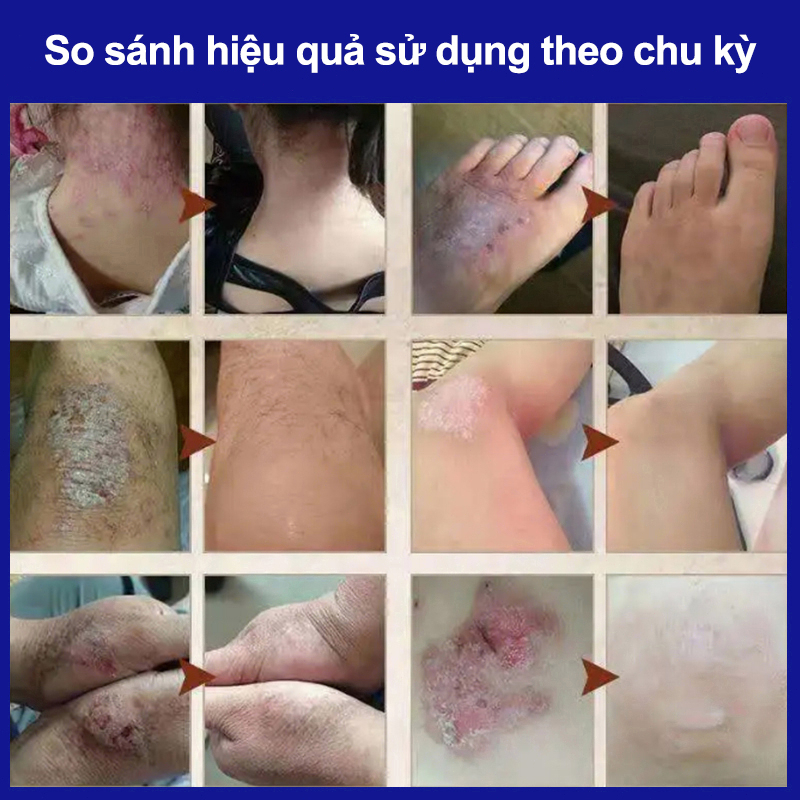 Kem bôi nấm ngứa thuốc bôi ngứa 20g thuốc trị ngứa Kem bôi vảy nến trị chàm trị ngứa trị vảy nến