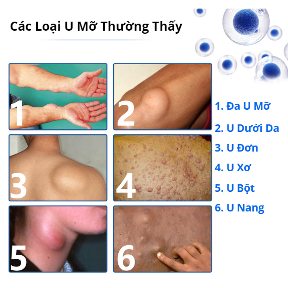 Xịt Trị U Mỡ Loại Bỏ Mỡ Thừa Làm Đẹp Cơ Thể Nhanh Chóng Dành Cho Nam Và Nữ | BigBuy360 - bigbuy360.vn