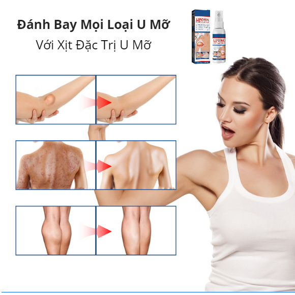 Xịt Trị U Mỡ Loại Bỏ Mỡ Thừa Làm Đẹp Cơ Thể Nhanh Chóng Dành Cho Nam Và Nữ | BigBuy360 - bigbuy360.vn