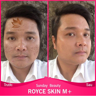 [Peel da] Peel da ROYCE SKIN M+ Da bong mảng to peel da làm đẹp theo xu hướng
