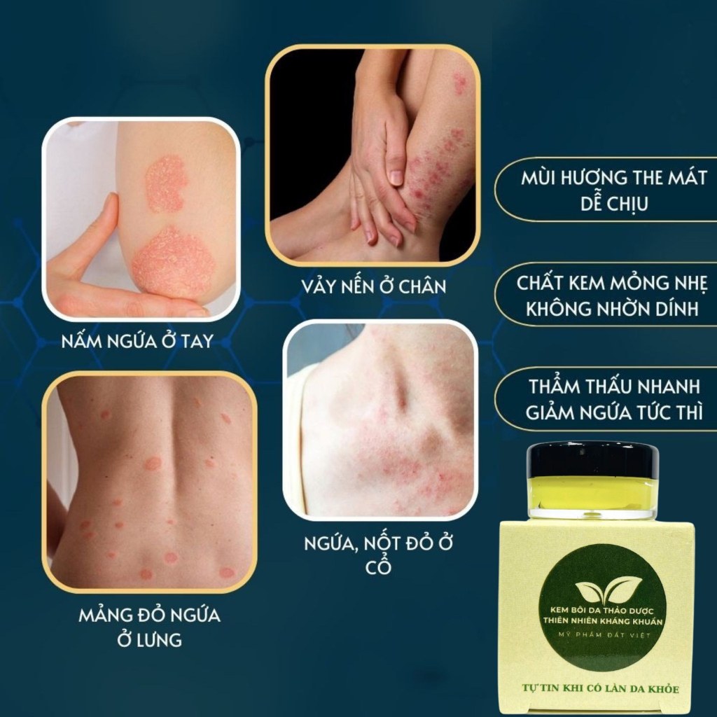Kem bôi Viem da cơ địa, vảy nến, nấm ngứa, á sừng, hắc lào, nứt nẻ tay chân