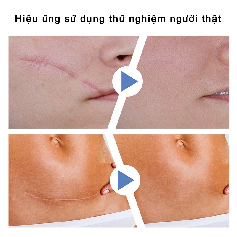 Miếng Dán Liền Sẹo Flushy Scar Tape - Miếng Dán Flushy Thảo Dược Hỗ Trợ Làm Mờ Da Sẹo, Phục Hồi Da