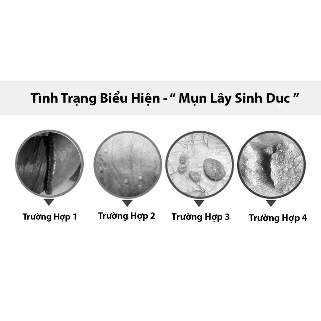 ADAM STRONGs giúp loại bỏ sùi mào gà, gai sinh duc, hạt ngọc dv sau 5 ngày sử dụng an toàn hiệu quả nhanh ( che tên )