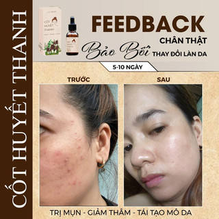 Chấm Mụn Thảo Dược Cốt Huyết Thanh