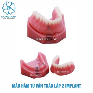 Mẫu tư vấn tháo lắp 2 implant, 4 implant - Hàm tư vấn nha khoa, Mẫu tư vấn nha khoa