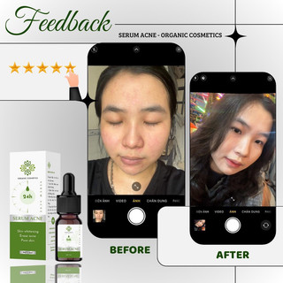 [Sẵn] Serum Acne 24h 5ml
