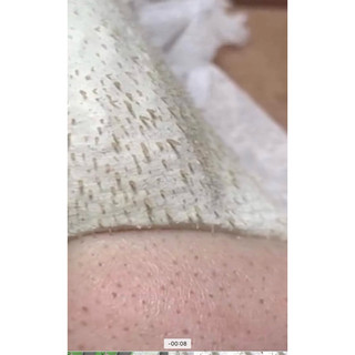 Gel hút mụn Titione