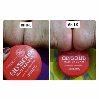 Kem Nẻ Glysolid Hautbalsam Đức hũ 100ml