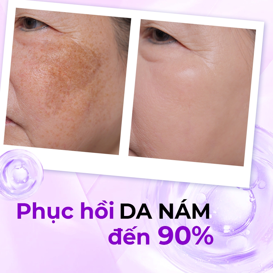 COMBO CHUYÊN SÂU Kem Nám - Tàn Nhang - Đồi Mồi + Kem Mụn - Mờ Thâm - Liền Sẹo akala ( Tế Bào Mầm Tái Sinh & Collagen
