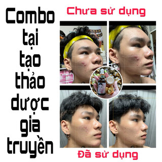 Combo tái tạo thảo dược gia truyền spa hx