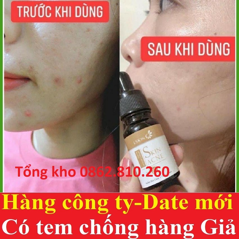 Cốt mụn Bạch Sen Lskin Đan Thy thi skin care acne - sản phẩm chính hãng