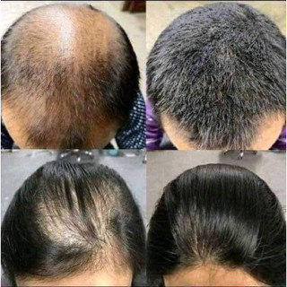 [Chính hãng] XỊT MỌC TÓC THÁI LAN HAIR TONIC GENIVE