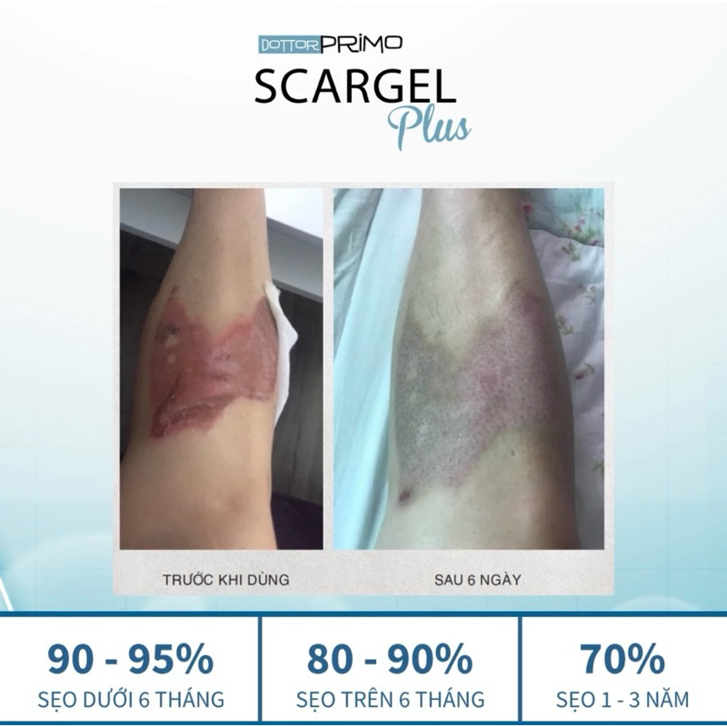 [CHÍNH HÃNG]SCARGEL PLUS LÀM MỜ SẸO ,NGĂN NGỪA SẸO CỦA CHÂU ÂU ITALY