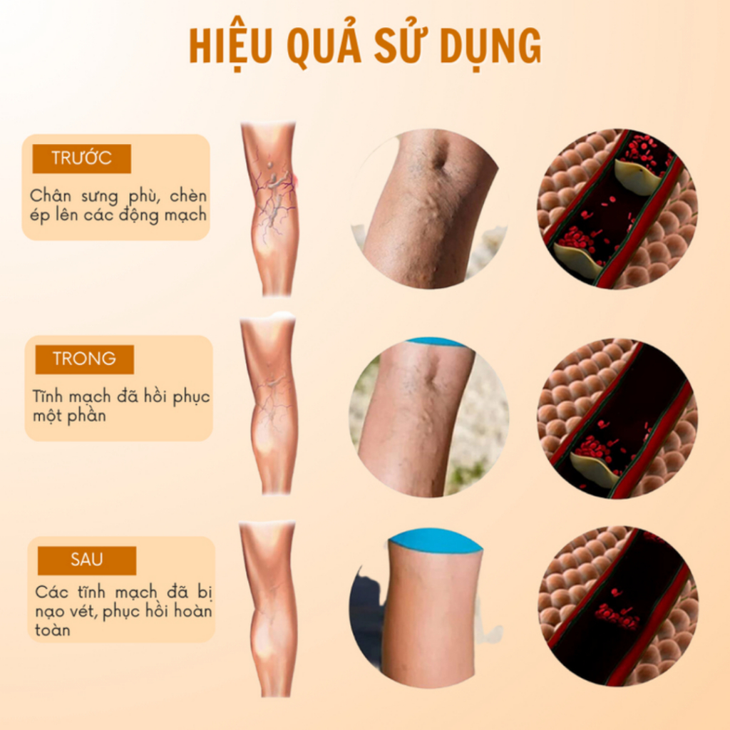 Miếng Dán Giãn Tĩnh Mạch South Moon - Làm Bền Thành Mạch, Giảm Sưng, Phù Nề, Tăng Cường Lưu Thông Máu Hộp 12 miếng|Moska