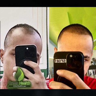 Serum Mọc Tóc Minoxidil Morr F5 (60ml) Chính Hãng Ấn Độ