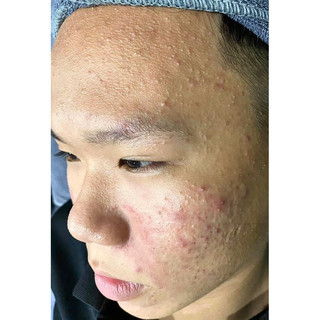 SERUM MỤN DR P.ACNE