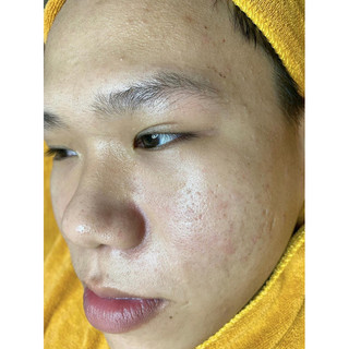 SERUM MỤN DR P.ACNE